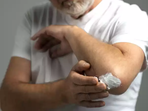 Est-il vrai que le beurre apaise les brûlures légères ?